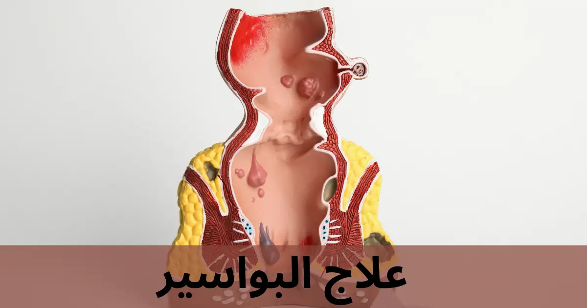 علاج البواسير
