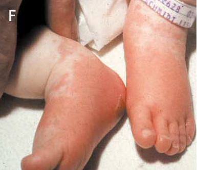 انتفاخ-في-الرجلين-مرض-كاواساكي